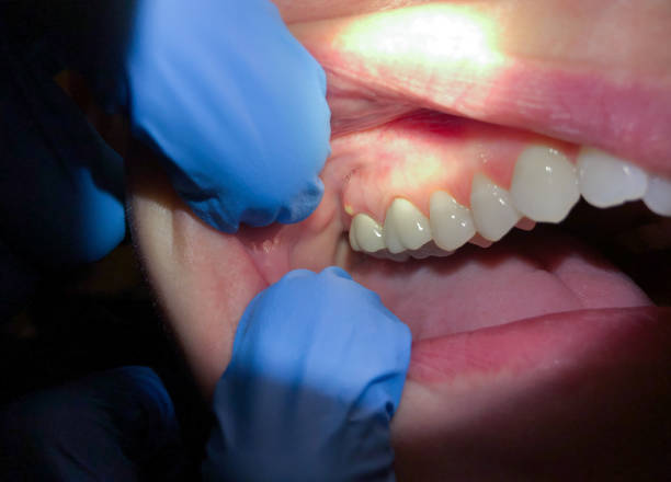 Best Emergency Treatment for Dental Infections or Abscesses in New York Mills, NY
